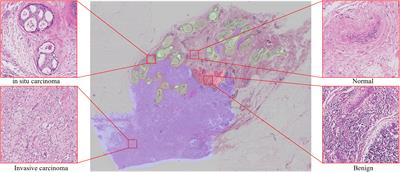 A semi-supervised learning approach with consistency regularization for tumor histopathological images analysis